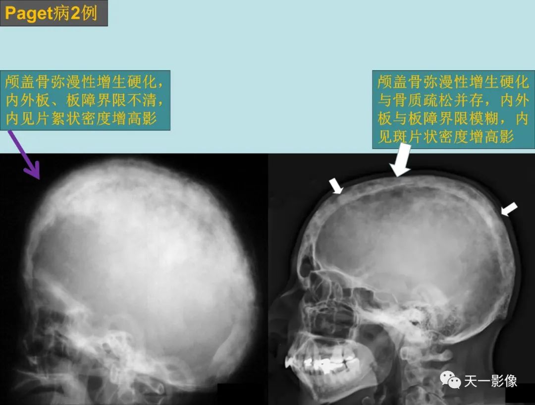 影像PPT - 【PPT】颅骨畸形性骨炎-5