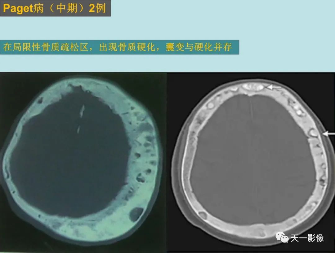 影像PPT - 【PPT】颅骨畸形性骨炎-6