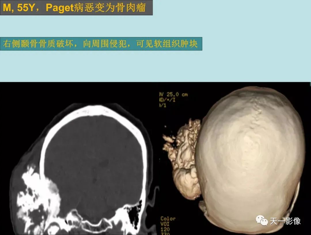 影像PPT - 【PPT】颅骨畸形性骨炎-7