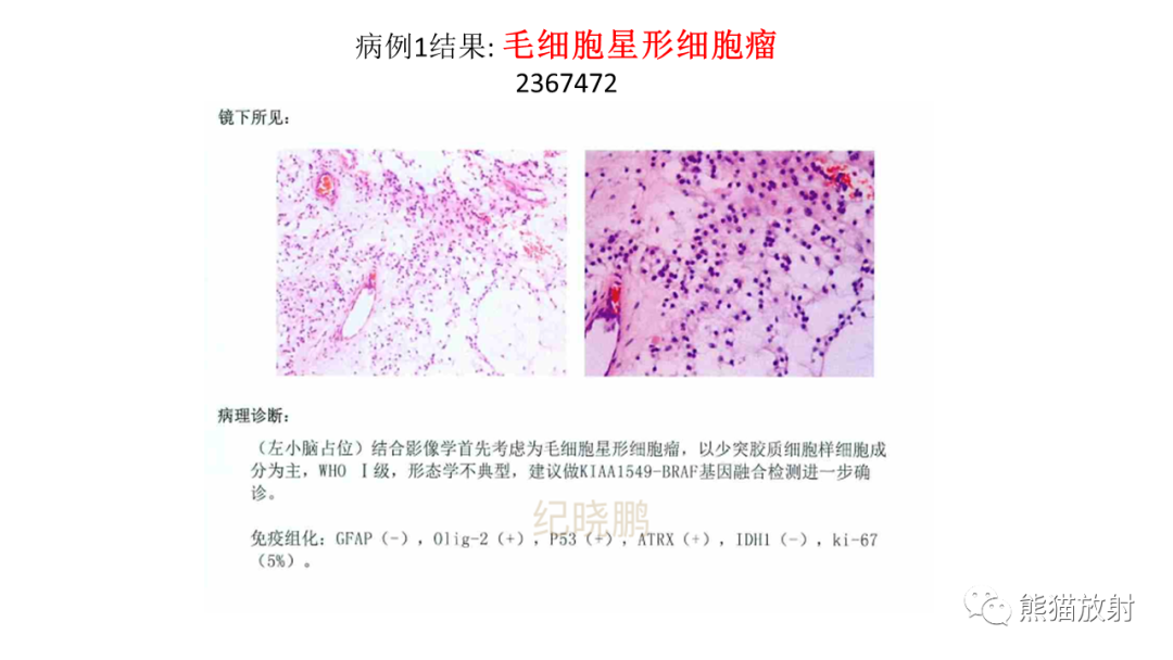 影像PPT - 【PPT】儿童后颅窝肿瘤—毛细胞型星形细胞瘤VS髓母细胞瘤-23
