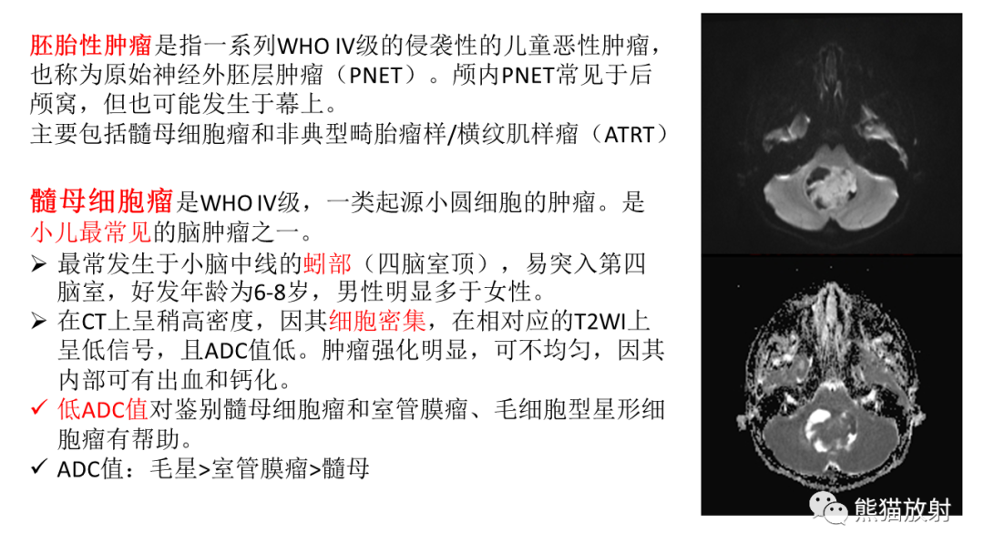 影像PPT - 【PPT】儿童后颅窝肿瘤—毛细胞型星形细胞瘤VS髓母细胞瘤-26