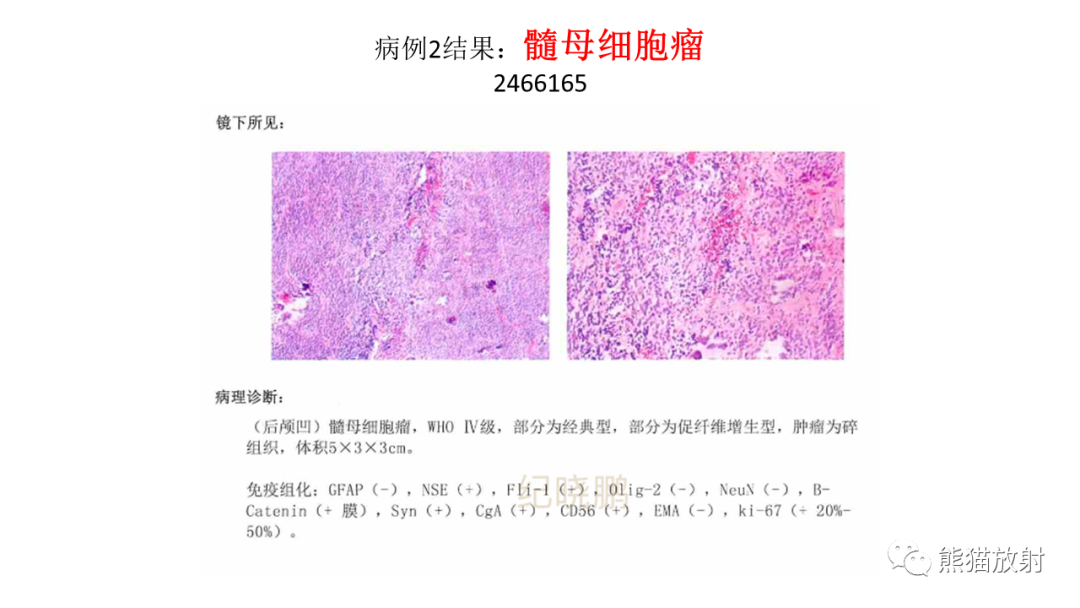 影像PPT - 【PPT】儿童后颅窝肿瘤—毛细胞型星形细胞瘤VS髓母细胞瘤-24