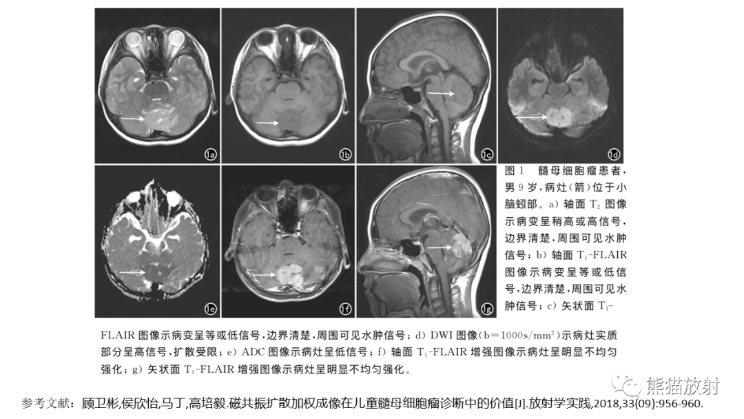 影像PPT - 【PPT】儿童后颅窝肿瘤—毛细胞型星形细胞瘤VS髓母细胞瘤-27