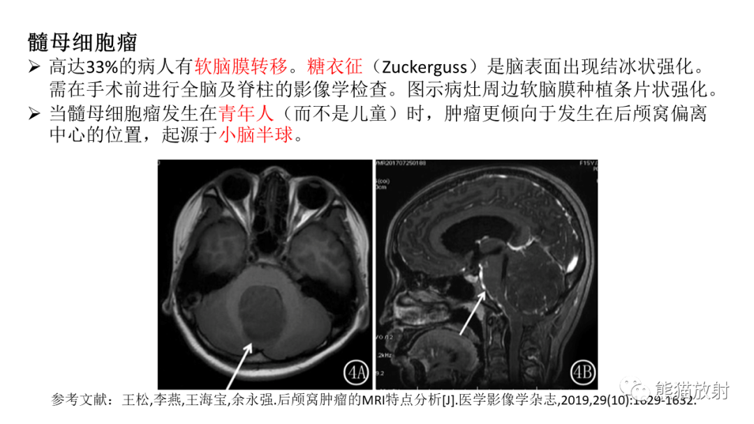 影像PPT - 【PPT】儿童后颅窝肿瘤—毛细胞型星形细胞瘤VS髓母细胞瘤-28