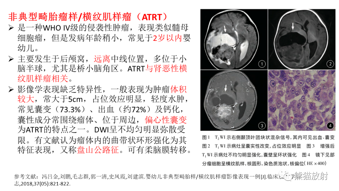影像PPT - 【PPT】儿童后颅窝肿瘤—毛细胞型星形细胞瘤VS髓母细胞瘤-29