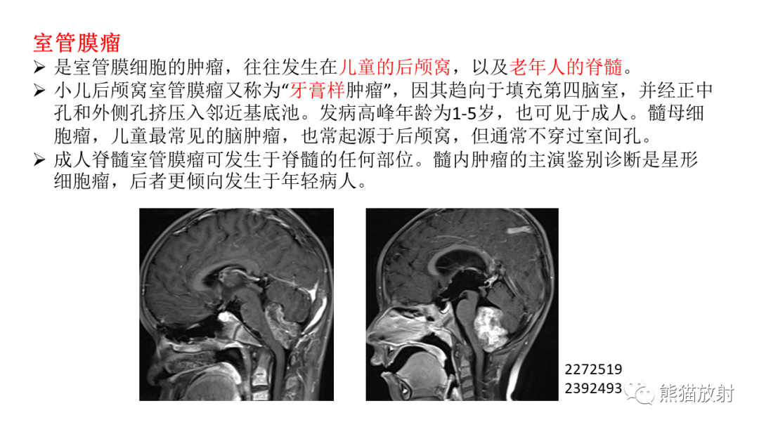 影像PPT - 【PPT】儿童后颅窝肿瘤—毛细胞型星形细胞瘤VS髓母细胞瘤-31
