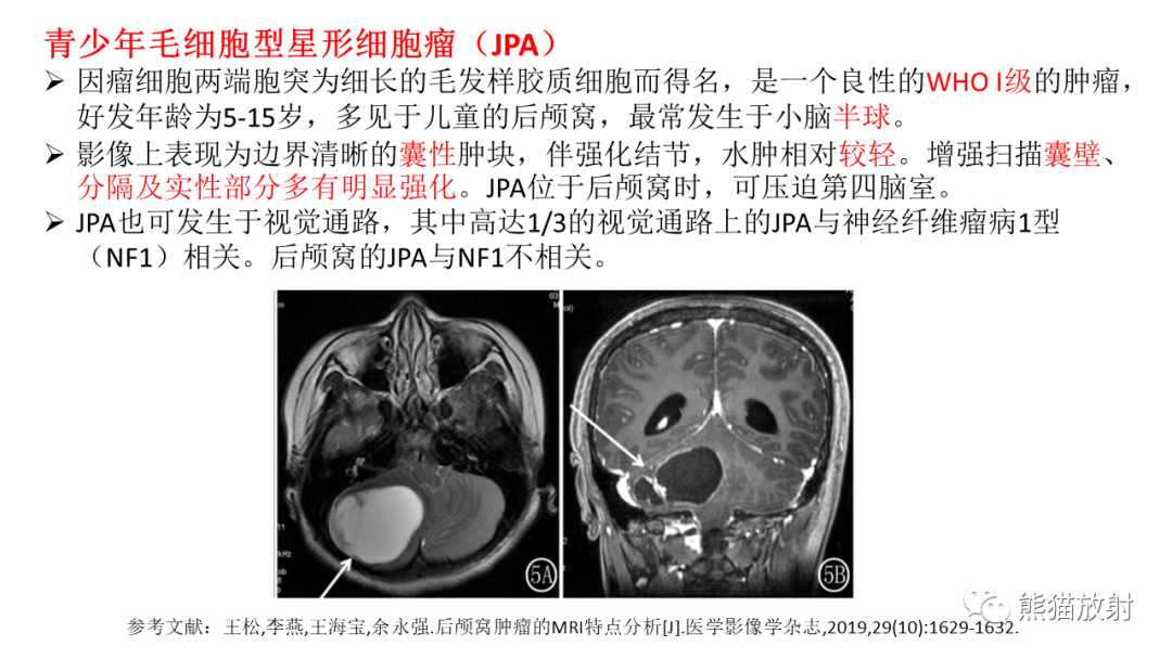 影像PPT - 【PPT】儿童后颅窝肿瘤—毛细胞型星形细胞瘤VS髓母细胞瘤-32