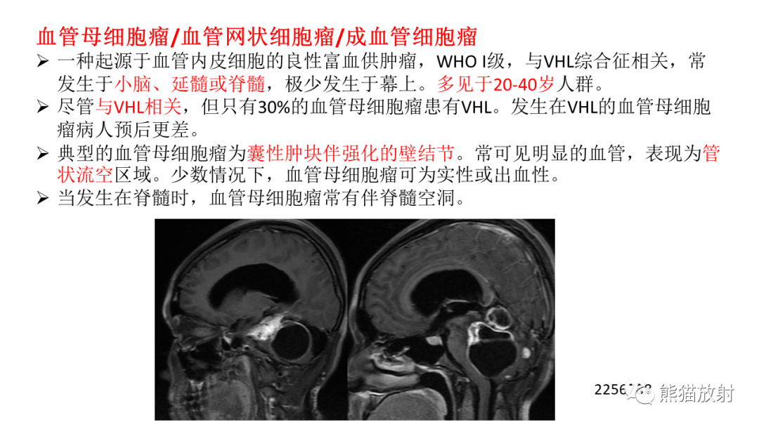 影像PPT - 【PPT】儿童后颅窝肿瘤—毛细胞型星形细胞瘤VS髓母细胞瘤-33