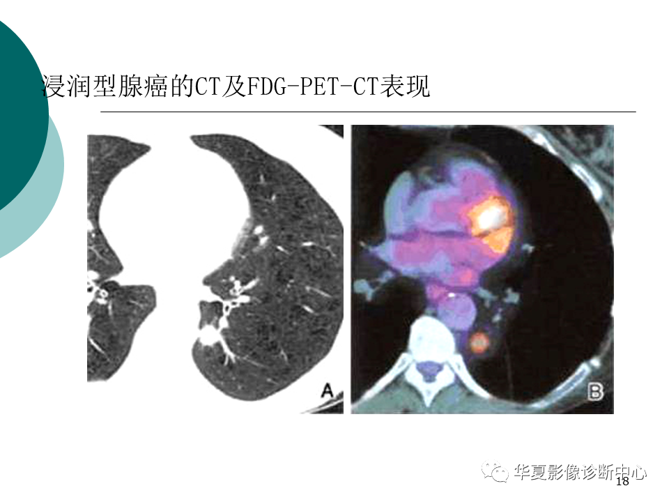 影像PPT - 【PPT】肺腺癌的新分类及影像学特点-18