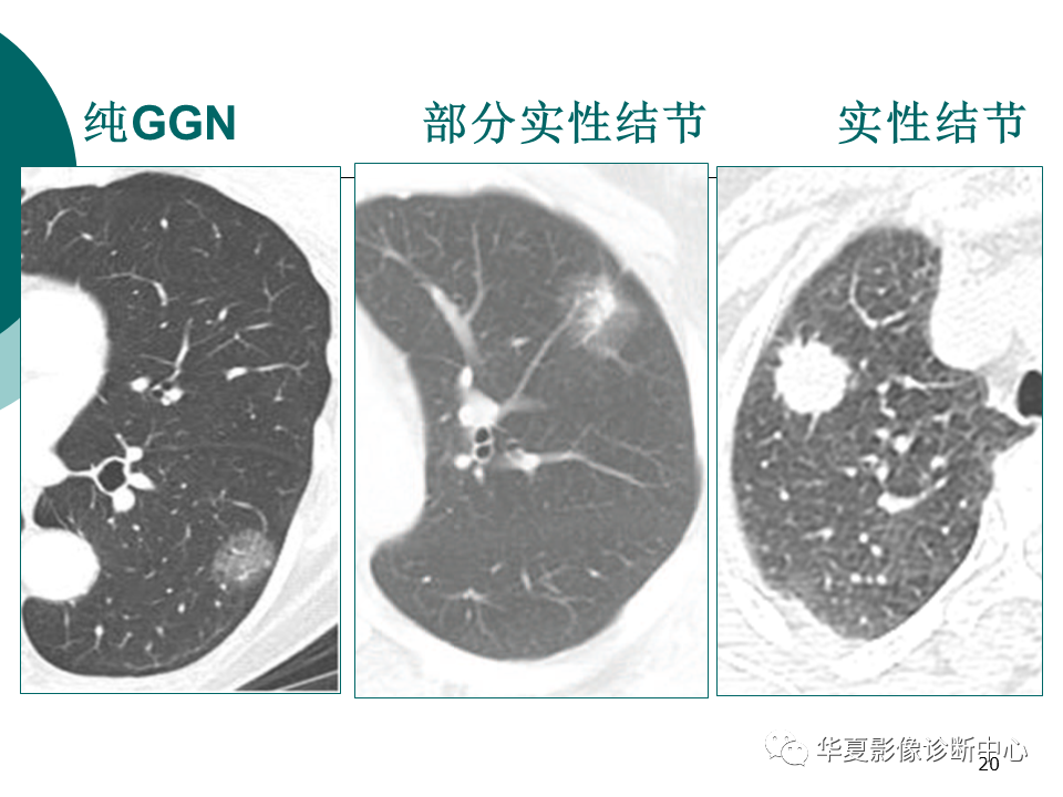 影像PPT - 【PPT】肺腺癌的新分类及影像学特点-20