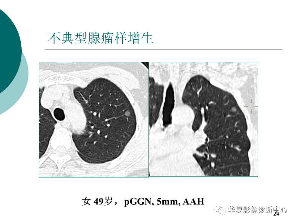 影像PPT - 【PPT】肺腺癌的新分类及影像学特点-24