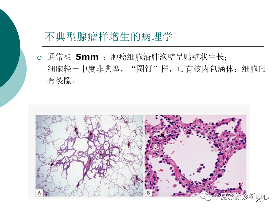 影像PPT - 【PPT】肺腺癌的新分类及影像学特点-25