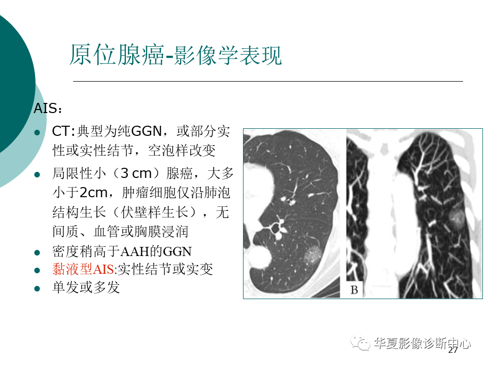 影像PPT - 【PPT】肺腺癌的新分类及影像学特点-27