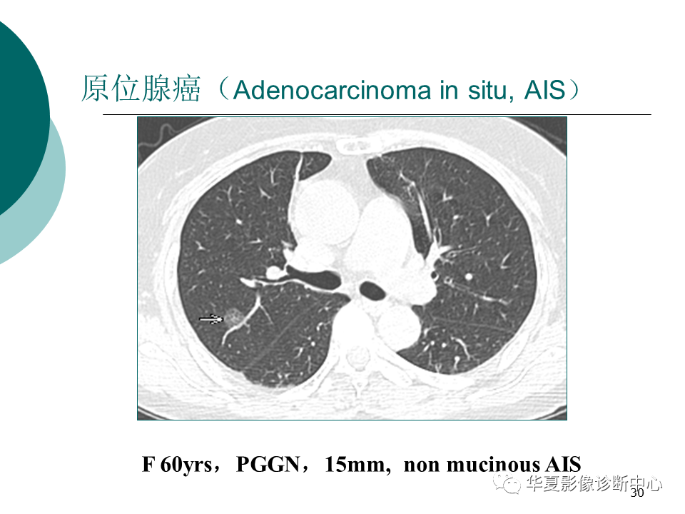 影像PPT - 【PPT】肺腺癌的新分类及影像学特点-30