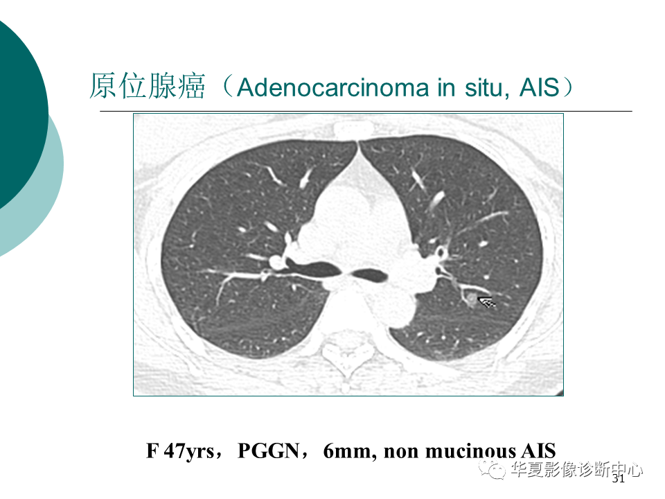 影像PPT - 【PPT】肺腺癌的新分类及影像学特点-31