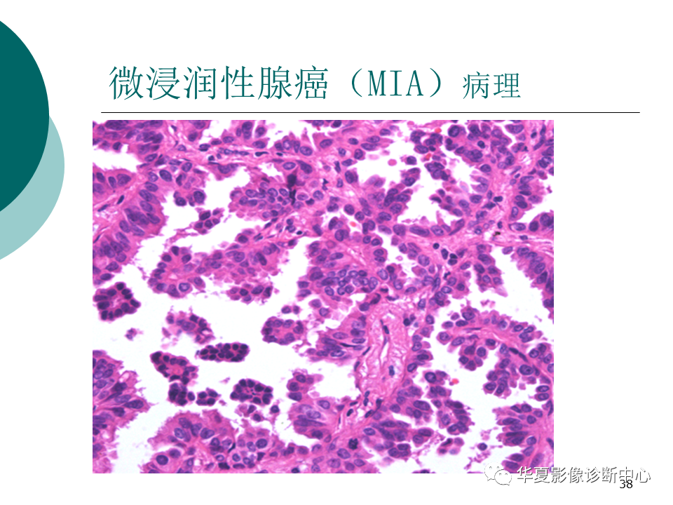 影像PPT - 【PPT】肺腺癌的新分类及影像学特点-38