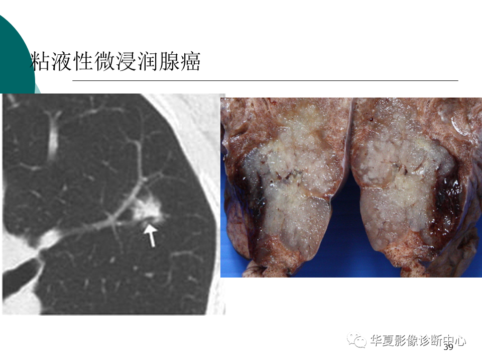 影像PPT - 【PPT】肺腺癌的新分类及影像学特点-39