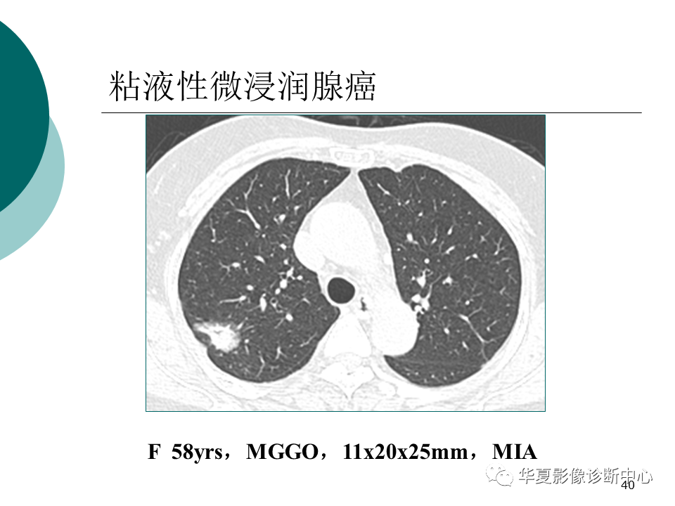 影像PPT - 【PPT】肺腺癌的新分类及影像学特点-40