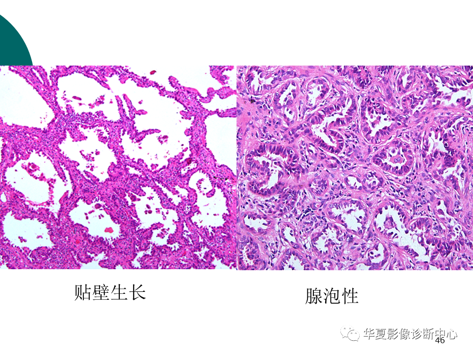 影像PPT - 【PPT】肺腺癌的新分类及影像学特点-46