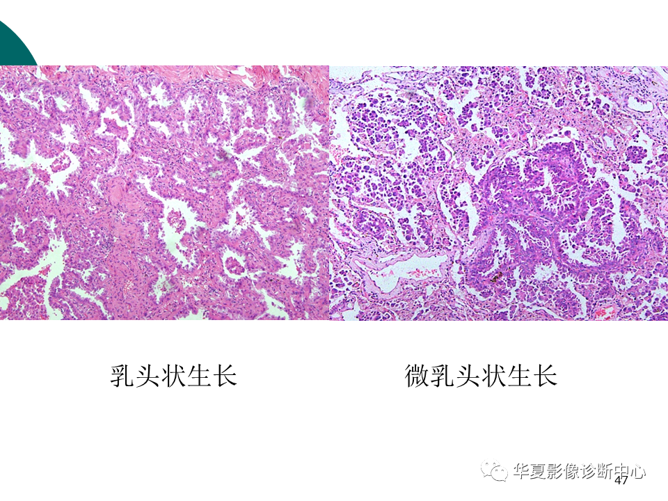 影像PPT - 【PPT】肺腺癌的新分类及影像学特点-47