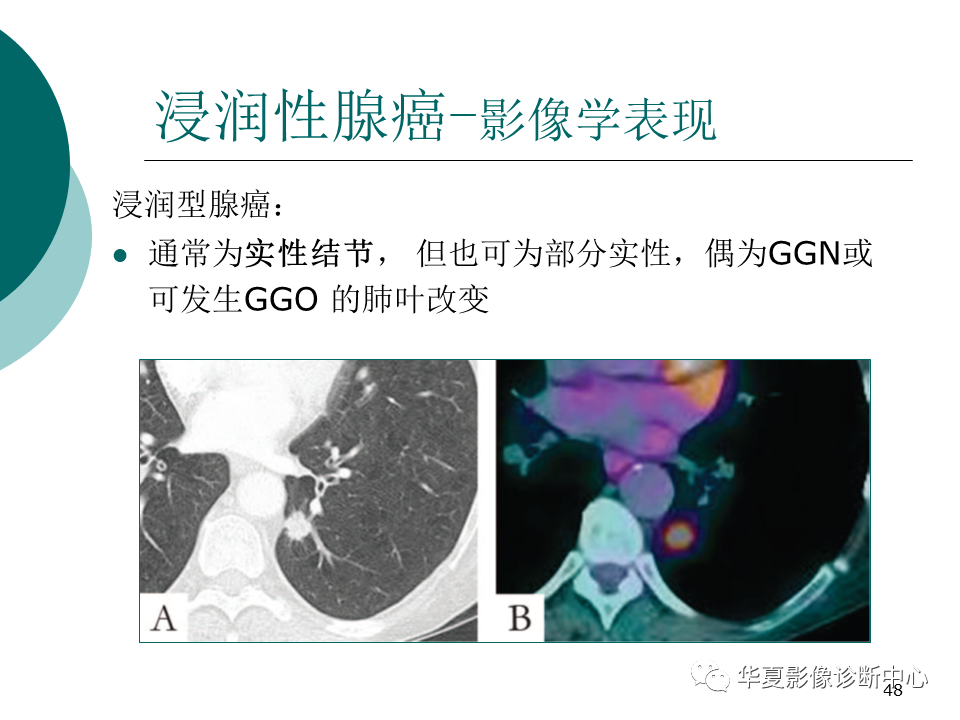 影像PPT - 【PPT】肺腺癌的新分类及影像学特点-48