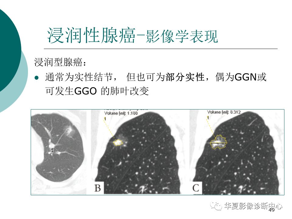 影像PPT - 【PPT】肺腺癌的新分类及影像学特点-49