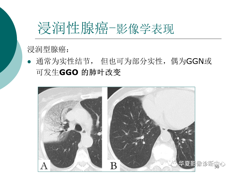 影像PPT - 【PPT】肺腺癌的新分类及影像学特点-50