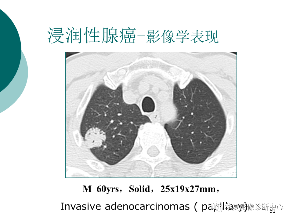 影像PPT - 【PPT】肺腺癌的新分类及影像学特点-51