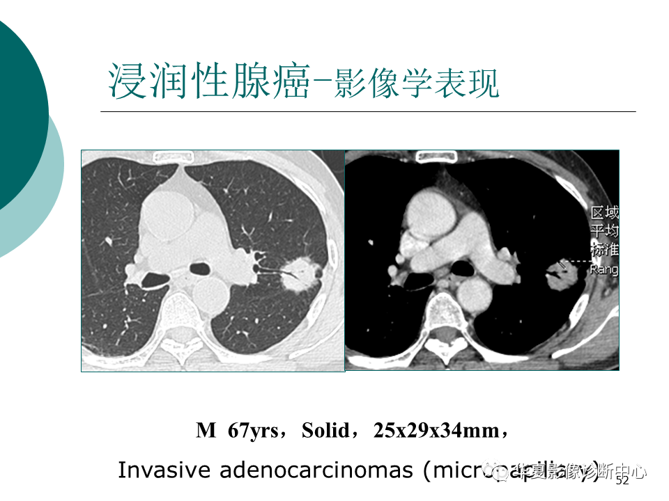 影像PPT - 【PPT】肺腺癌的新分类及影像学特点-52