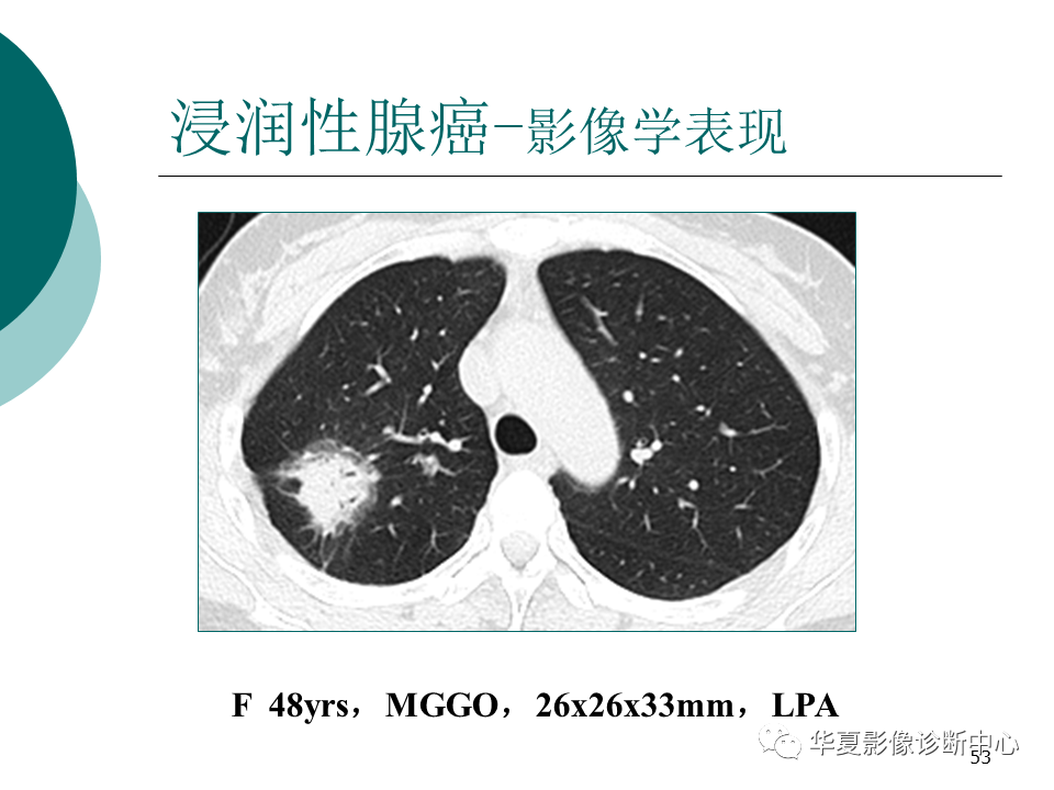 影像PPT - 【PPT】肺腺癌的新分类及影像学特点-53