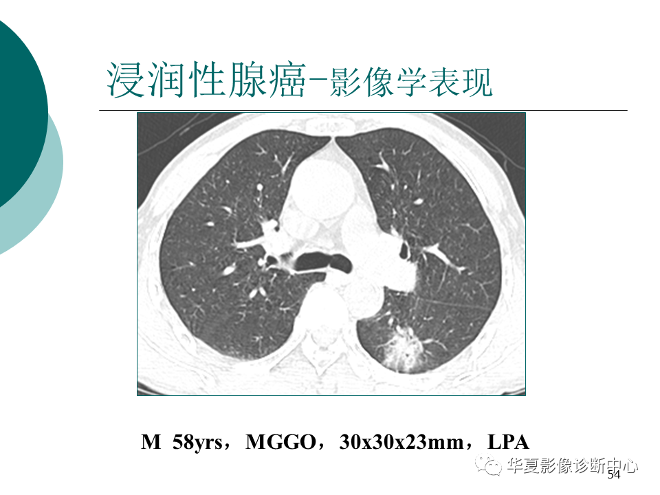 影像PPT - 【PPT】肺腺癌的新分类及影像学特点-54