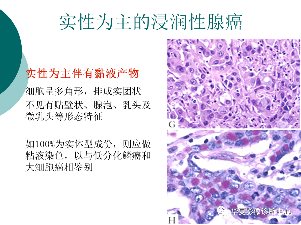 影像PPT - 【PPT】肺腺癌的新分类及影像学特点-55