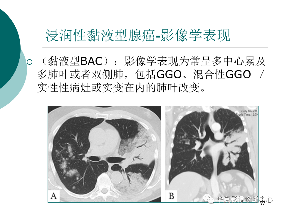 影像PPT - 【PPT】肺腺癌的新分类及影像学特点-57