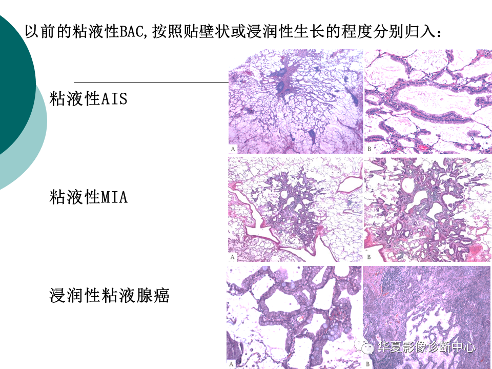 影像PPT - 【PPT】肺腺癌的新分类及影像学特点-56