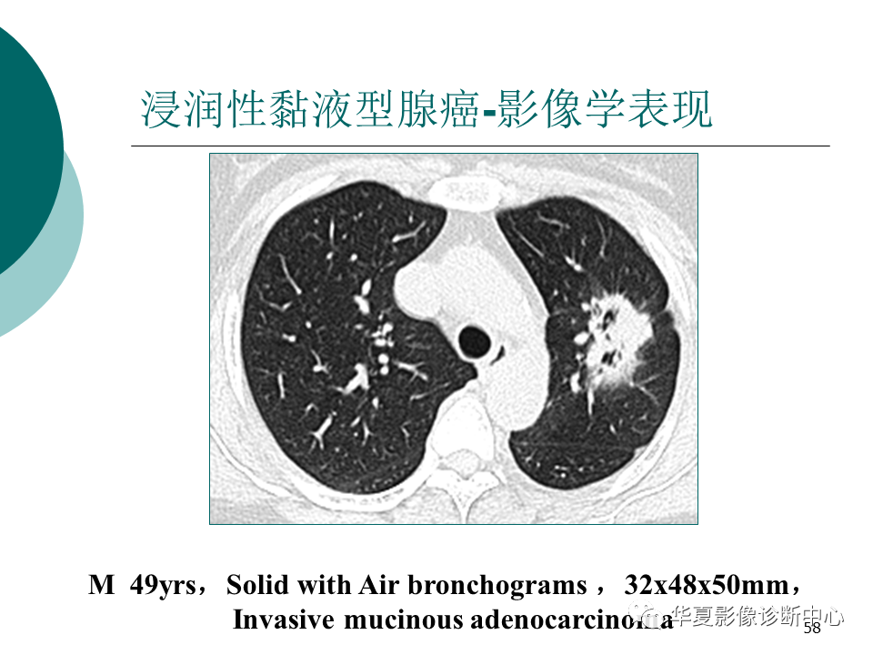 影像PPT - 【PPT】肺腺癌的新分类及影像学特点-58