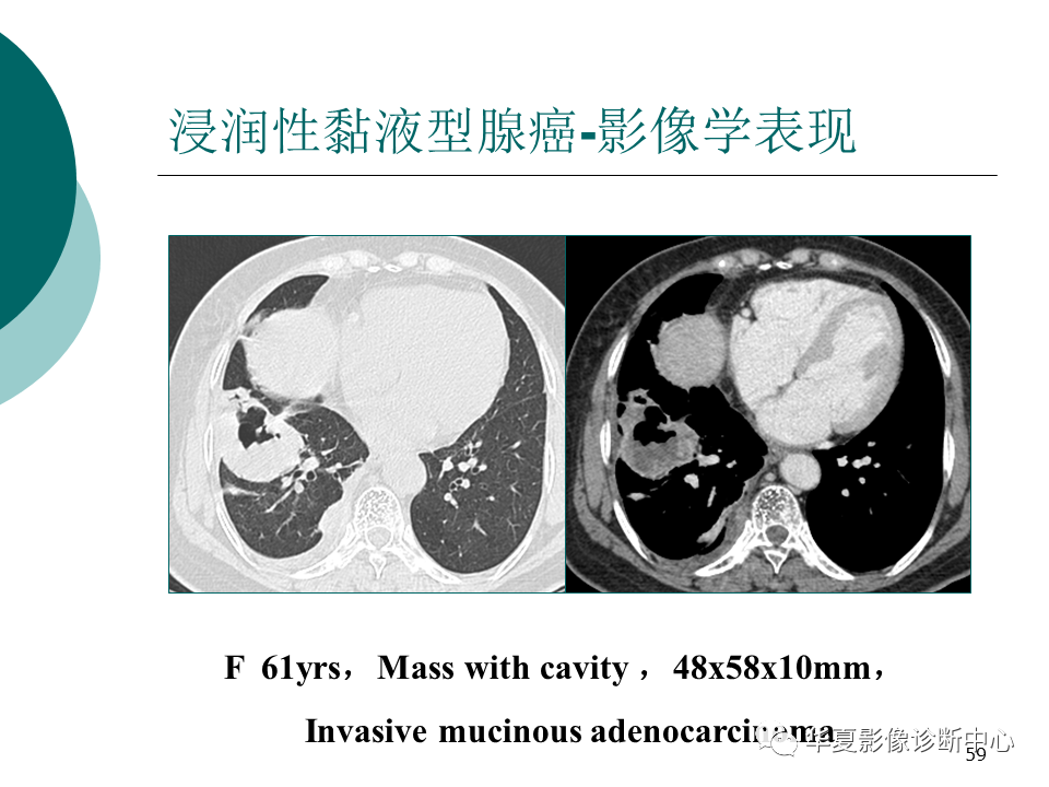 影像PPT - 【PPT】肺腺癌的新分类及影像学特点-59