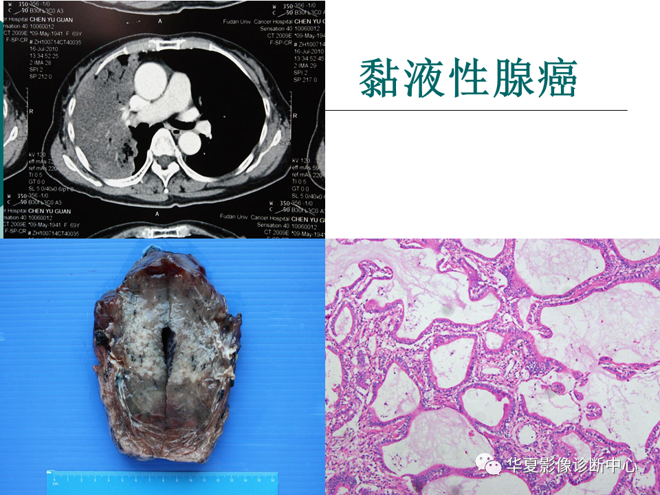 影像PPT - 【PPT】肺腺癌的新分类及影像学特点-60