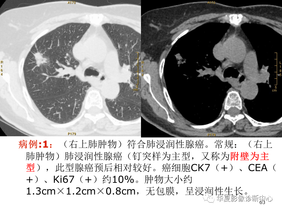 影像PPT - 【PPT】肺腺癌的新分类及影像学特点-63