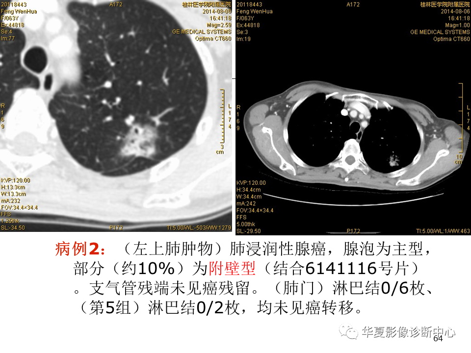 影像PPT - 【PPT】肺腺癌的新分类及影像学特点-64