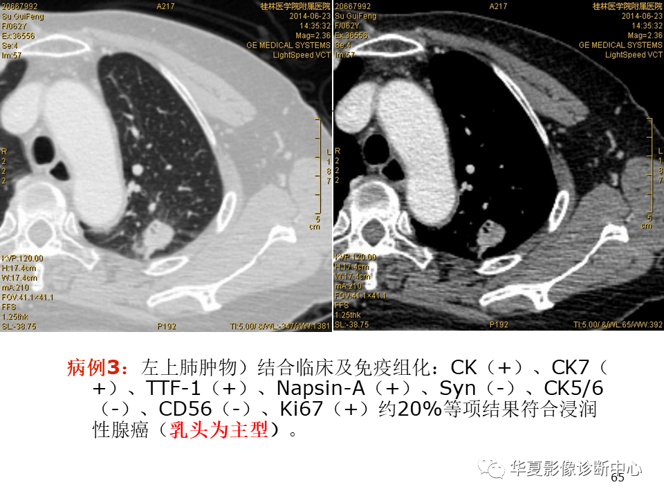影像PPT - 【PPT】肺腺癌的新分类及影像学特点-65
