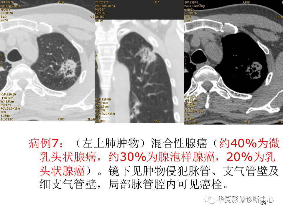 影像PPT - 【PPT】肺腺癌的新分类及影像学特点-69