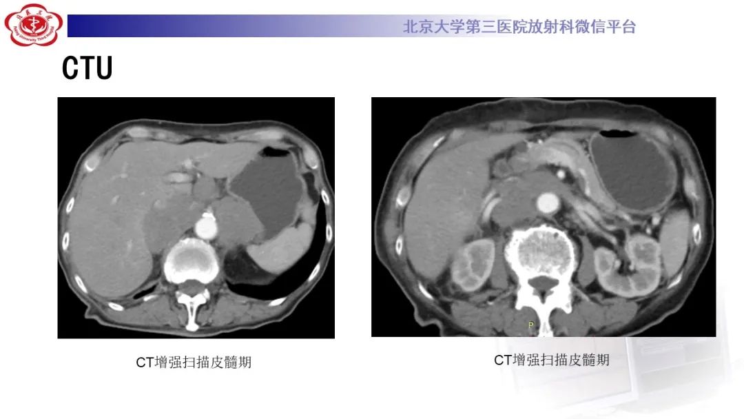 影像PPT - 【PPT】肾脏淋巴瘤-6