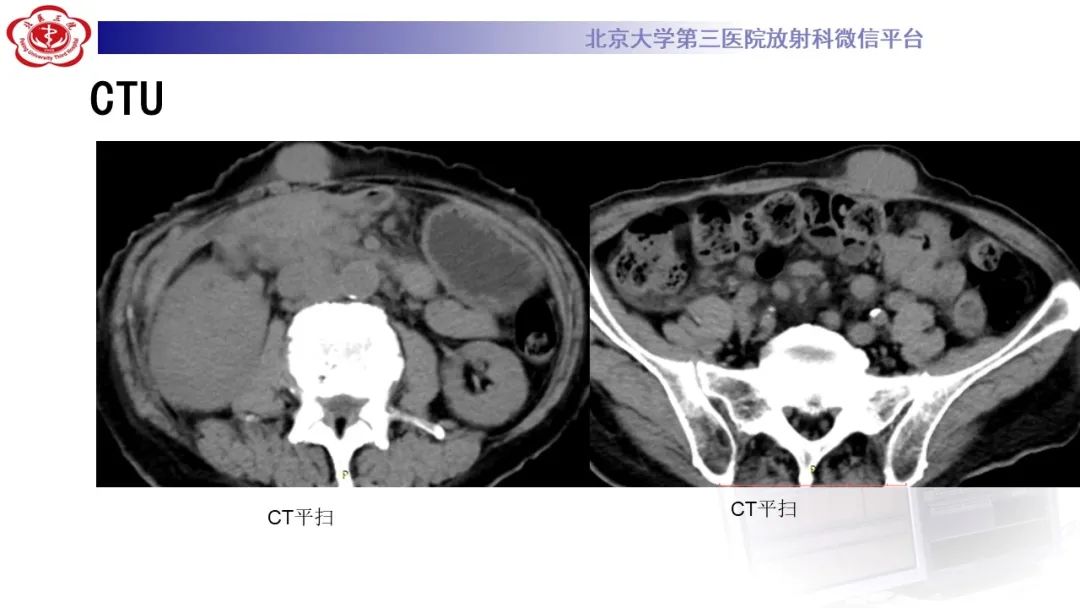 影像PPT - 【PPT】肾脏淋巴瘤-5
