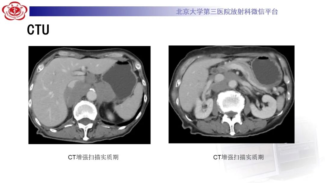 影像PPT - 【PPT】肾脏淋巴瘤-8