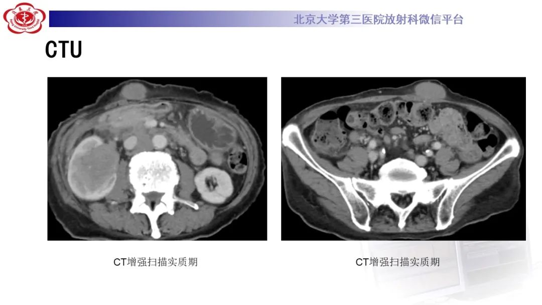 影像PPT - 【PPT】肾脏淋巴瘤-9