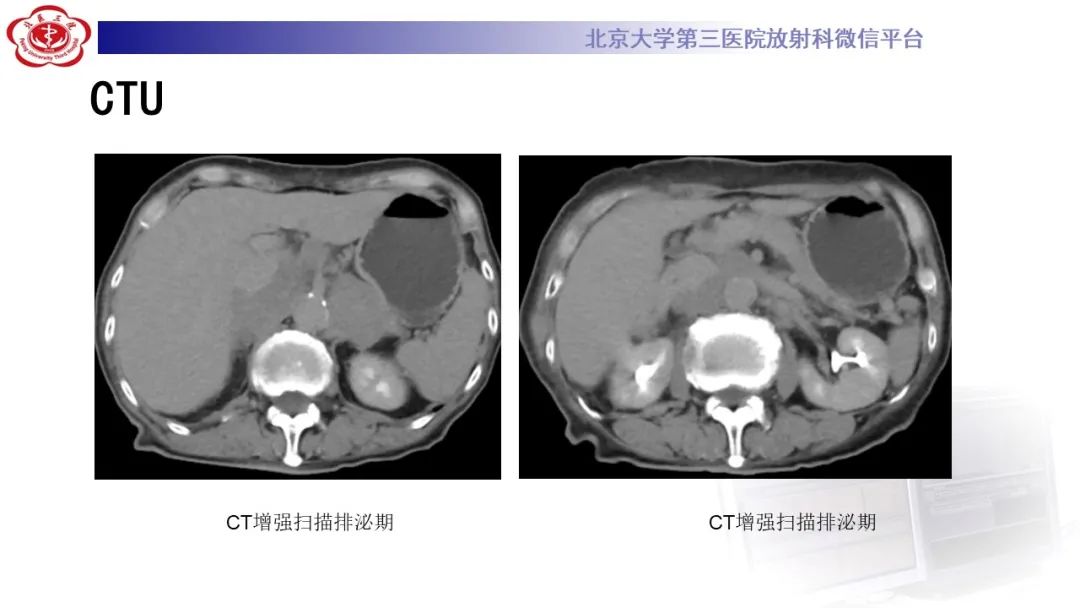 影像PPT - 【PPT】肾脏淋巴瘤-10