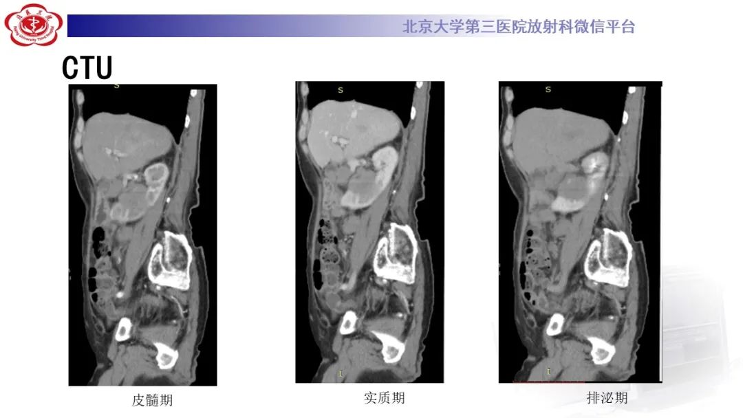 影像PPT - 【PPT】肾脏淋巴瘤-12