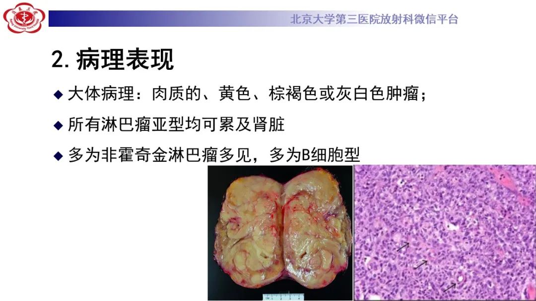影像PPT - 【PPT】肾脏淋巴瘤-19