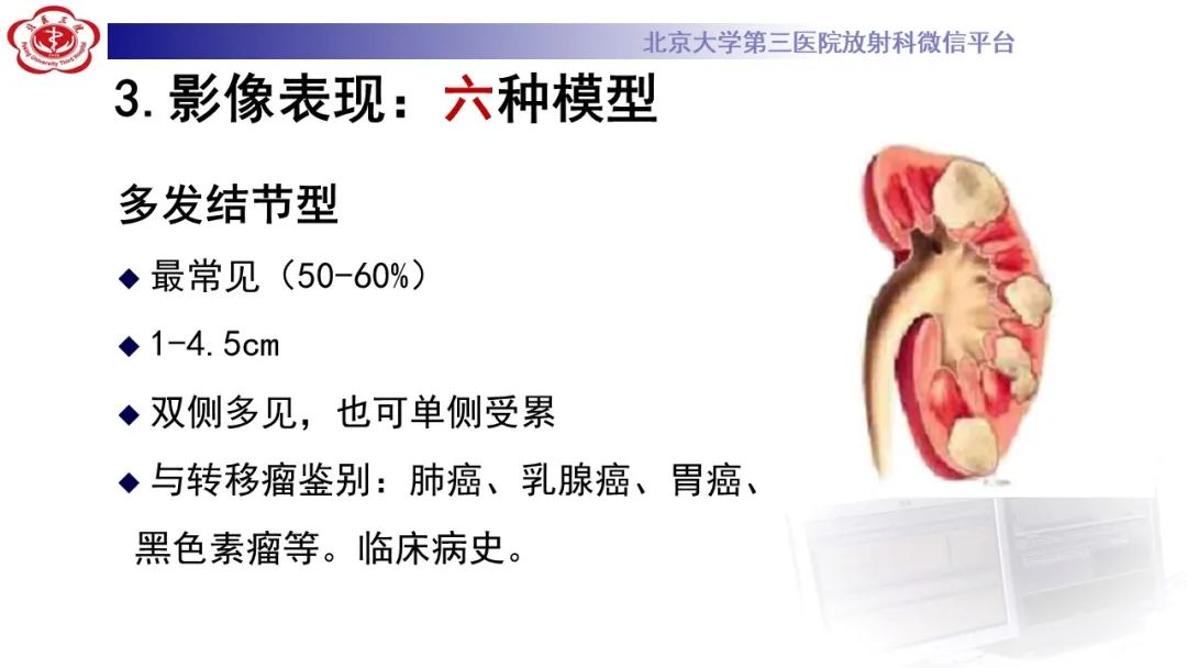 影像PPT - 【PPT】肾脏淋巴瘤-24