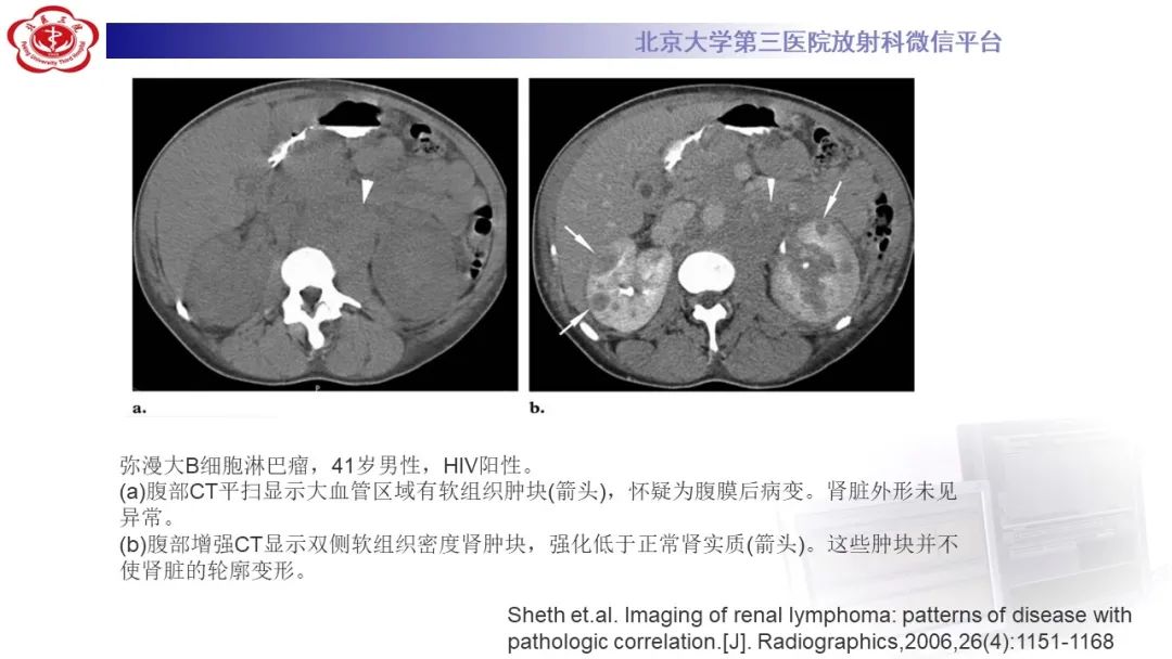 影像PPT - 【PPT】肾脏淋巴瘤-25